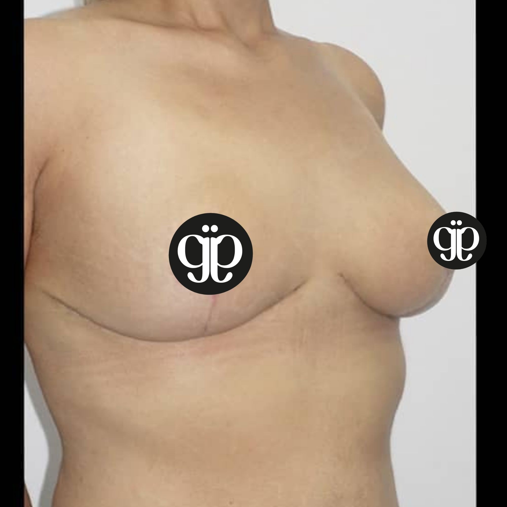 BREAST LIFT Breast 19 after Clinica Joia