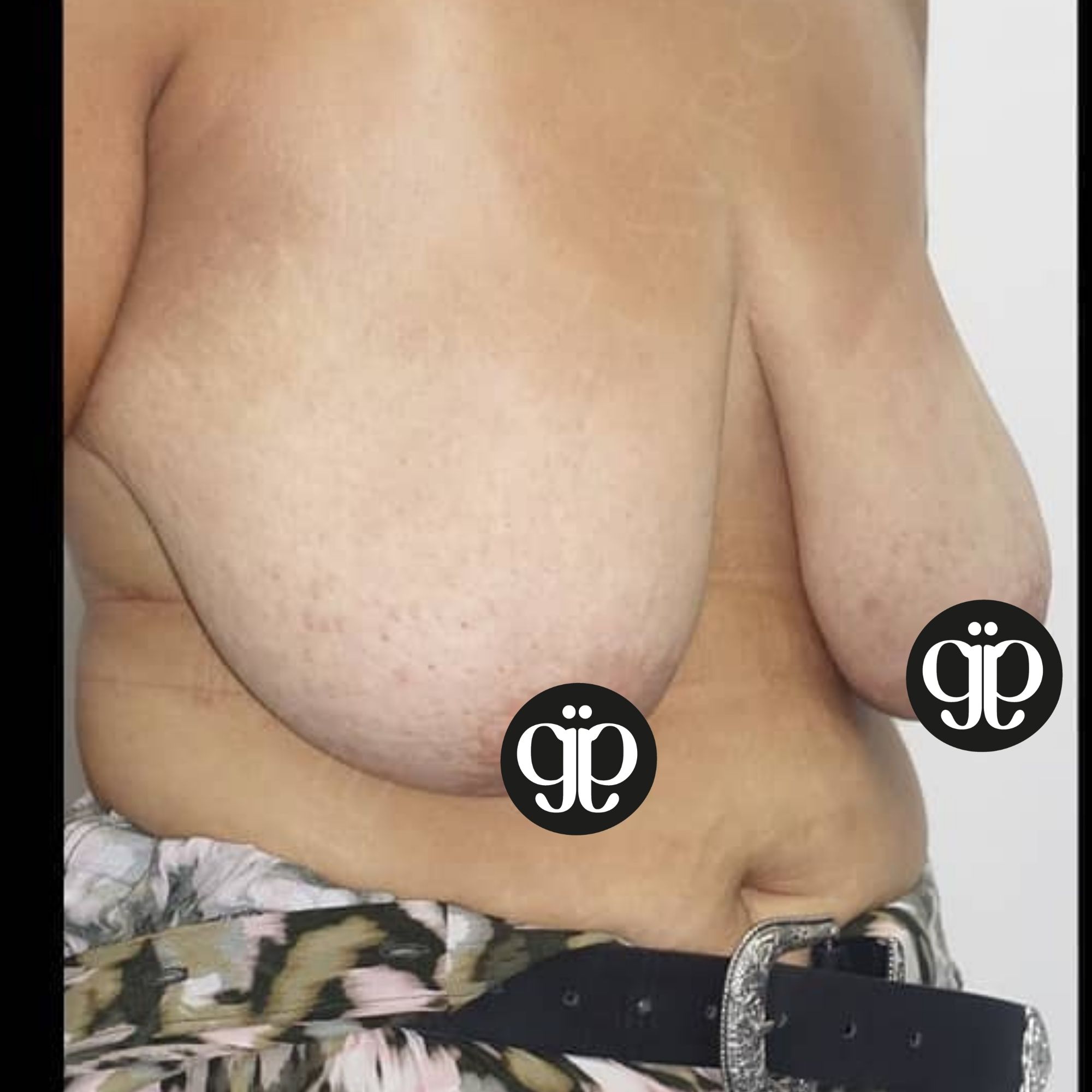 BREAST LIFT Breast 19 before Clinica Joia