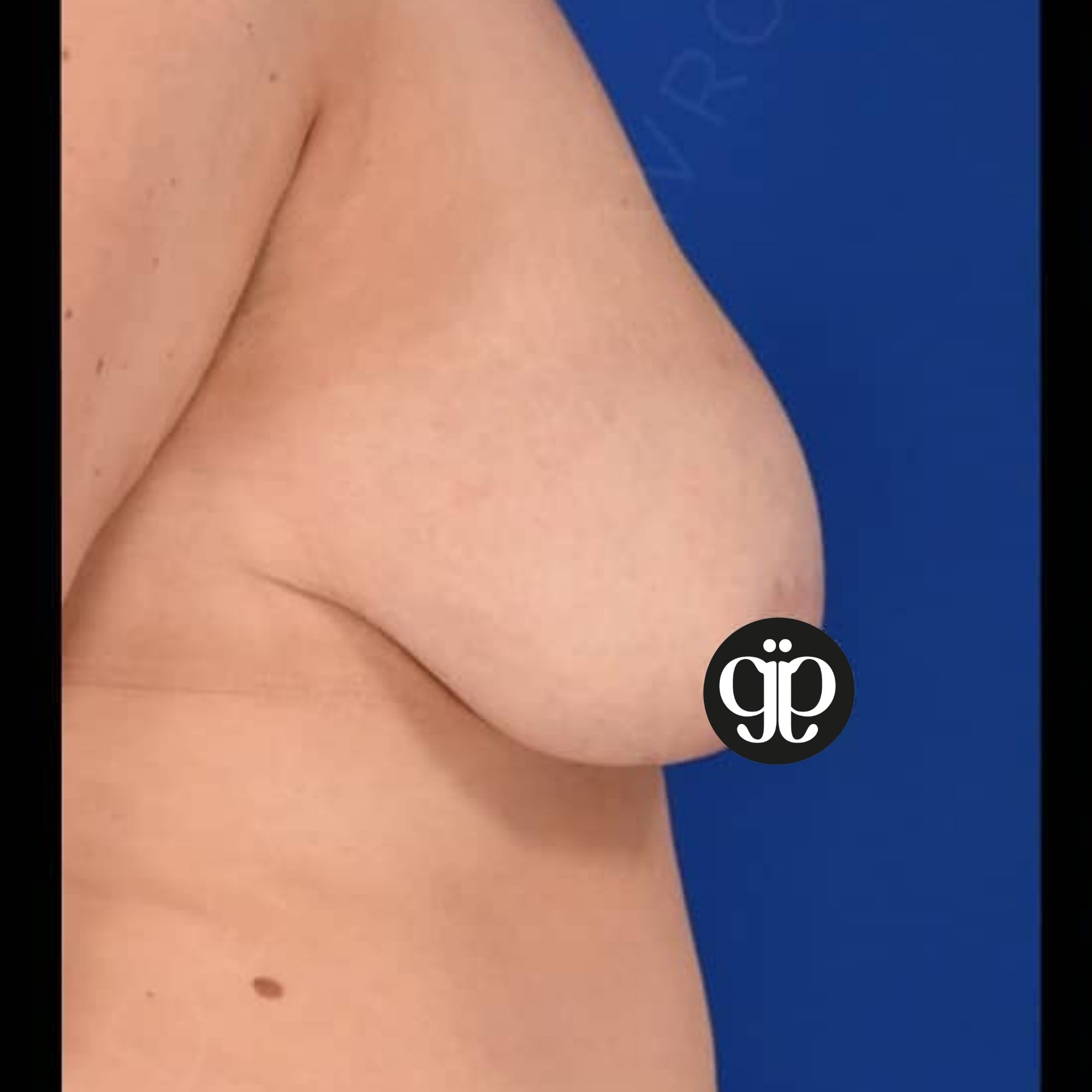 BREAST LIFT Breast 23 before Clinica Joia