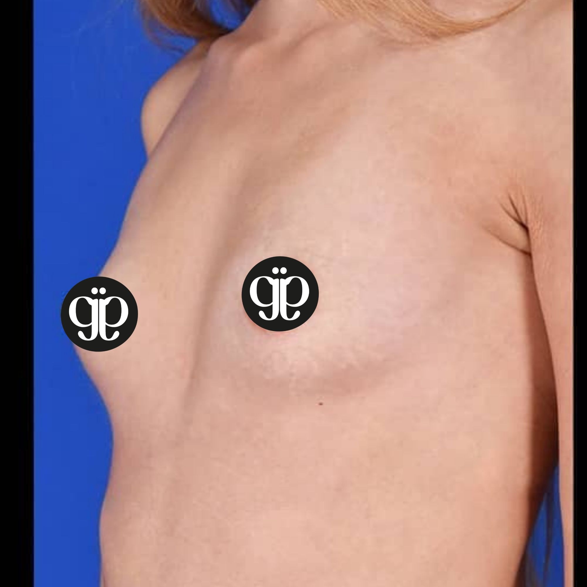 Breast 42 before Clinica Joia