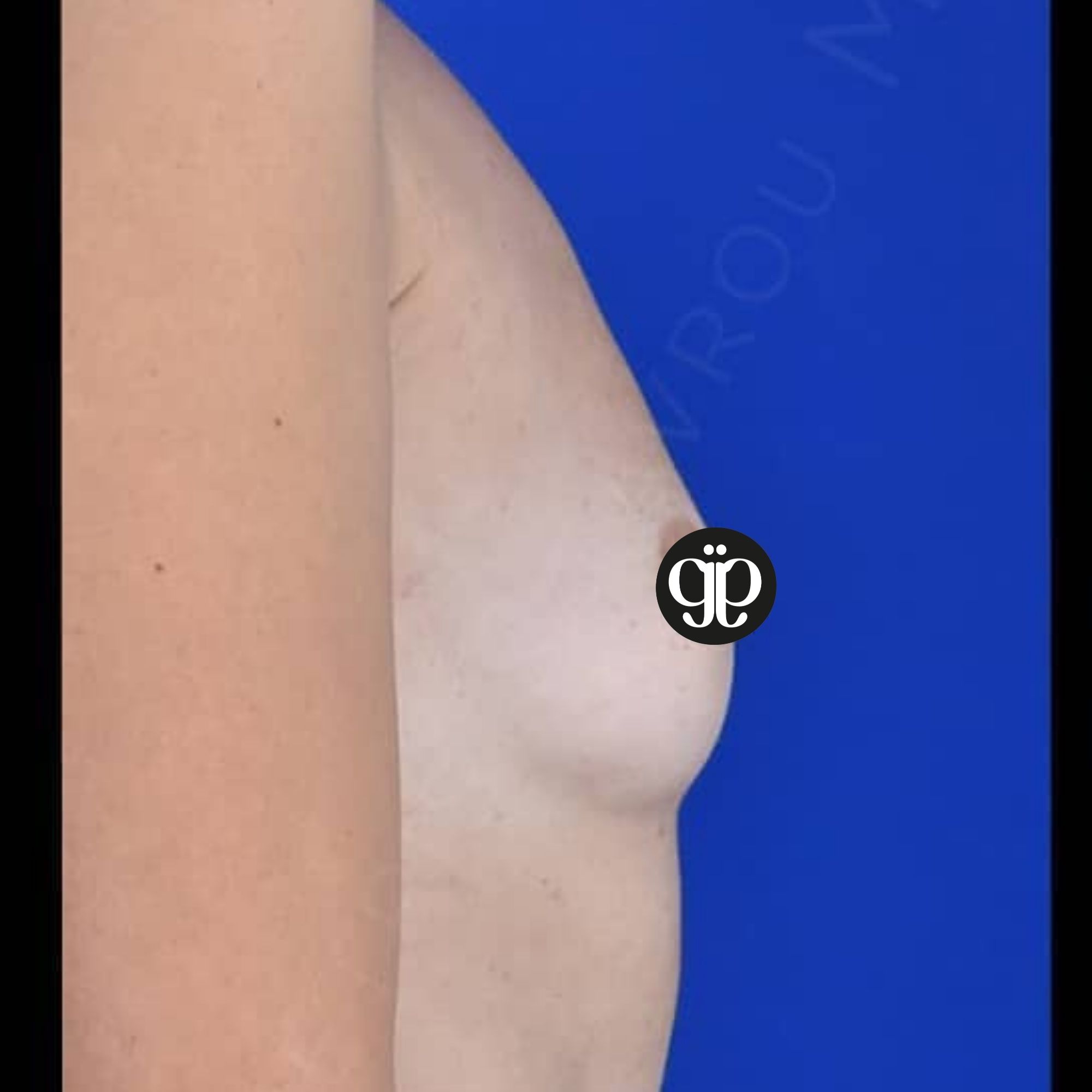 Breast 47 before Clinica Joia