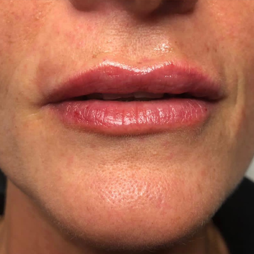 lips 14- after - clinica joia